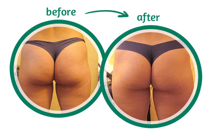 cellulite adipeuse