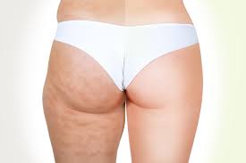comment enlever la cellulite