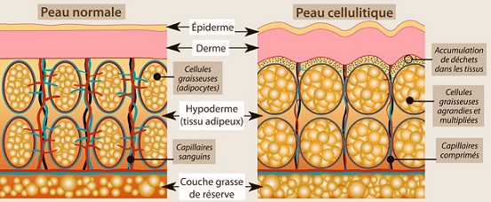 Comment faire pour ne plus avoir de cellulite