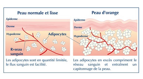 comment ne plus avoir de cellulite naturellement