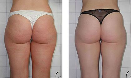 faire disparaître de la cellulite adipeuse
