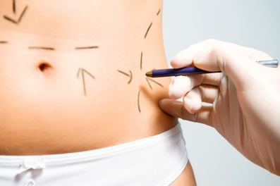 liposuccion ou CelluM6