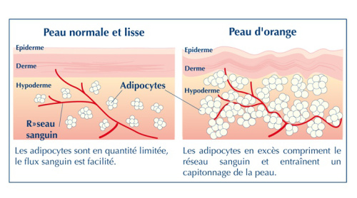 percutafeine anti cellulite