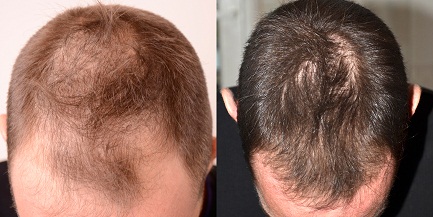 levure de bière pour cheveux